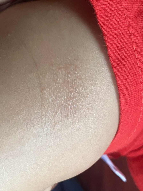 Mga mii,my nakganito ba skin ng baby nyo.
Anong  pwedeng gawin?