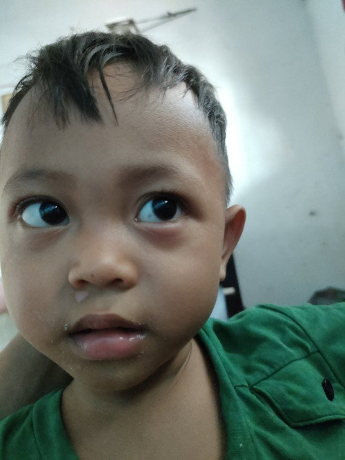 Penghilang bekas luka