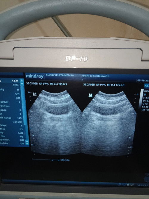 Usg terlihat kantong nya aja