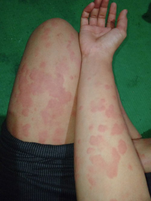 Biduran setelah lahiran 3 tahun 3 bulan lalu sampai sekarang hamil lagi