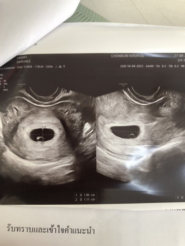 อัลตราซาวด์ทางช่องคลอด