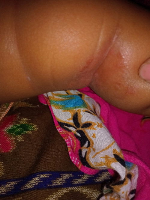 Bun anakku gatal seperti itu gimana ya?