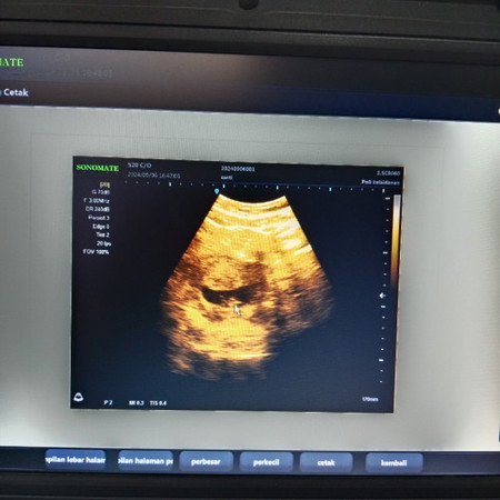 Bun aku baru USG usia kandungan ak10 minggu, hasil USG ny baru keliatan janin nya kecil. Ada yg sm?