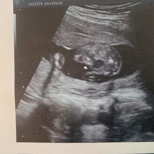 อยากรู้เพศลูกค่ะ ไป รพ ได้ซาวด์ไม่กี่ครั้งเองค่ะ