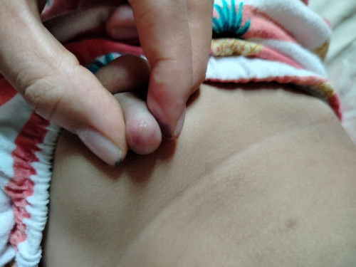 Hẹp bao quy đầu