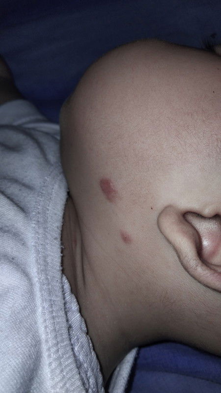 Bentol merah seperti keloid