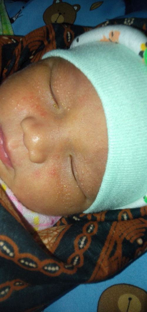 Bintik bintik di muka bayii