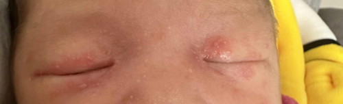 Red spots around baby’s eye
