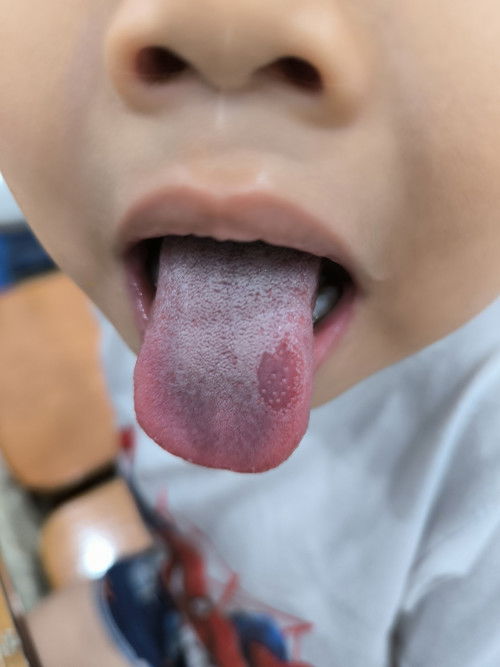 Lưỡi bé bị sao vậy ạ? Ai có kinh nghiệm cho e hỏi với ạ.