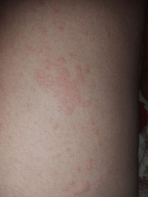 Gatal saat trimester 3