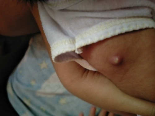 Parang nana sa injection site