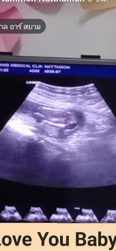 17 w 3 d น้องหนีบไว้มีใครดูออกมั้ยคะว่าหญิงหรือชาย