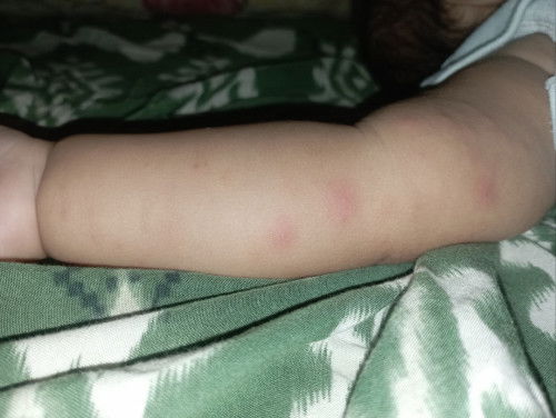 Beruntusan Merah pada bayi