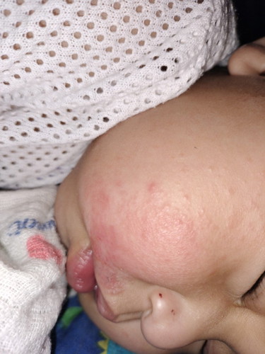 RUAM SUSU ATAU ECZEMA?