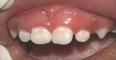 Baru 1 tahun gigi anak udah mau karies