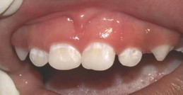 Baru 1 tahun gigi anak udah mau karies