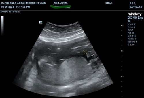 Hii ibu² semua, nk pinjam mata kejap. Agak² gamba scan ni baby boy ke girl yea (di arrow)