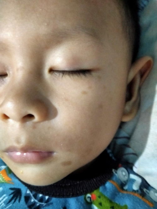 Bekas/flek hitam diwajah