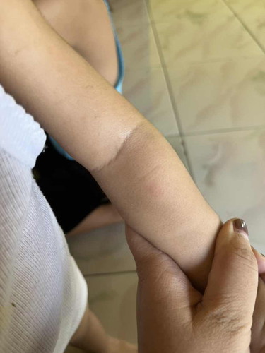 Bekas suntik mantoux