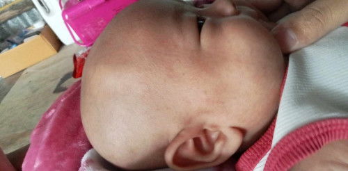 น้อง2เดือนค่ะมีผื่นขึ้นบนหัวอะคะ