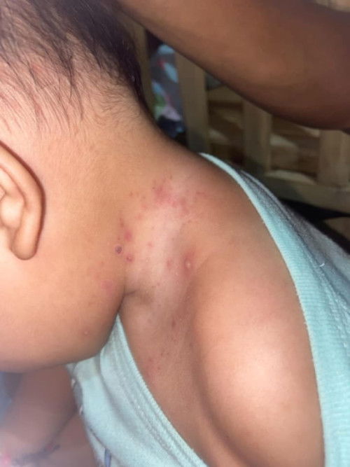 may tumutubo sa leeg ng baby ko