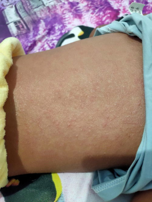 Ruam atau biang keringet