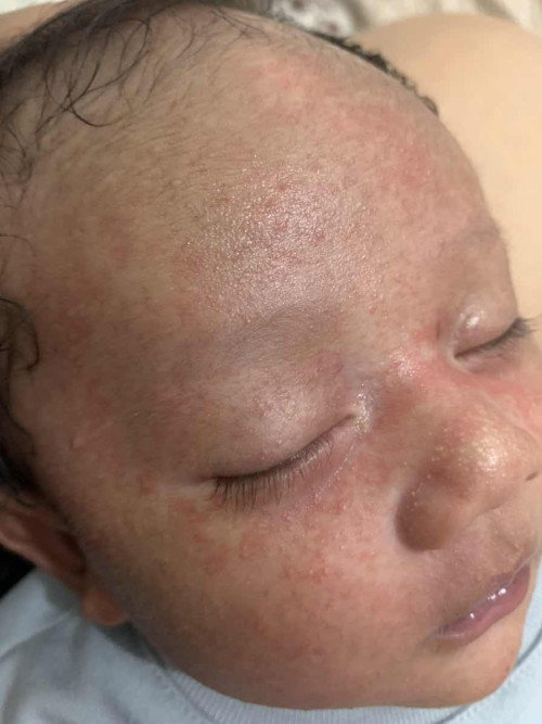 Berutusan muka dan badan