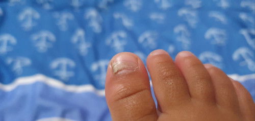 Kuku seperti mau lepas