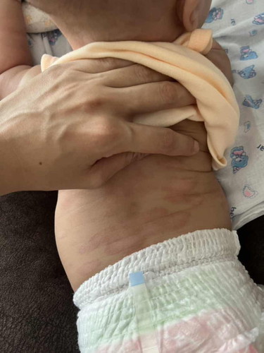 มีเจ้าตัวน้อยของแม่ๆคนไหนเคยเป็นบ้างคะ