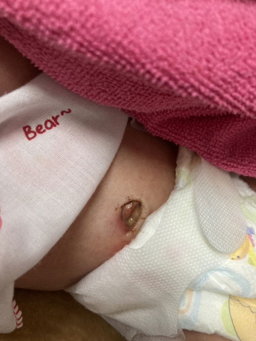 สะดือลูกหลุดแต่แผลแฉะควรทำไงดีค่ะ