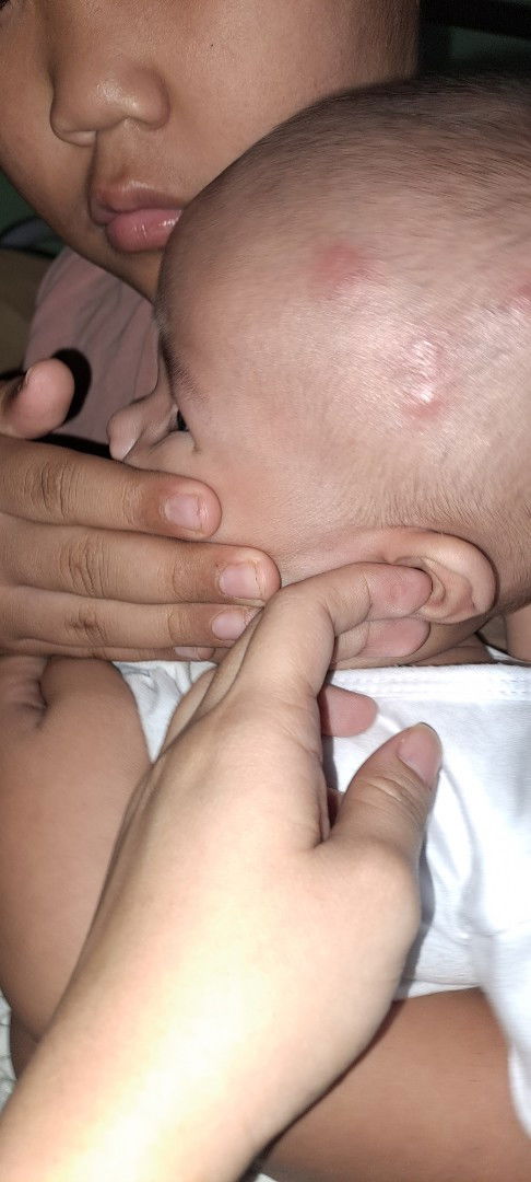 Kagat ng lamok or allergy