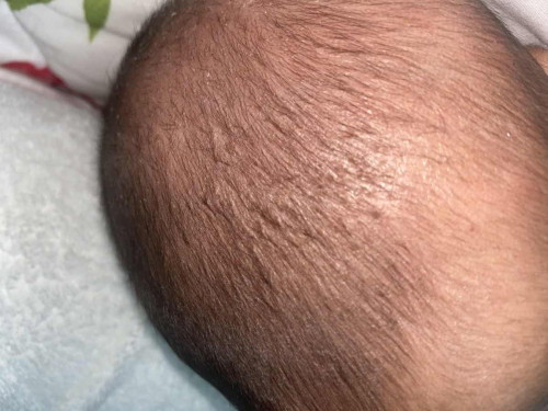 Kepala baby kudis / daki?