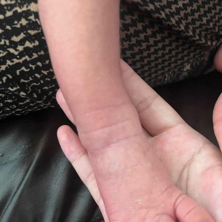 ผิวลูกลอกแตก