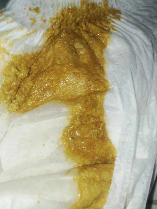 สองถามเรื่องการถ่ายของลูกว่าปกติไหม