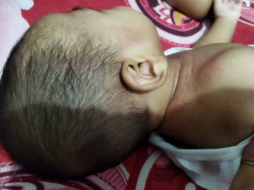 Bentol merah2 dan sebagian kyak ada air/nanah