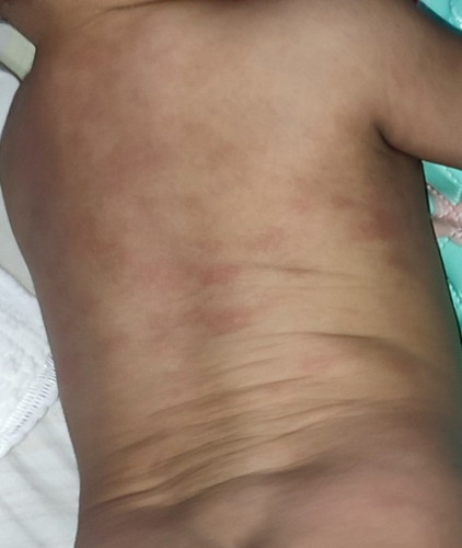 Bintik merah di belakang badan bayi