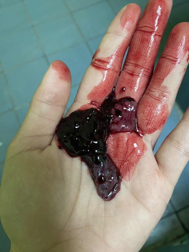 มีก้อนเลือดและชิ้นเนื้อแบบนี้ออกมาจะเป็นไรไหมคะ ?
