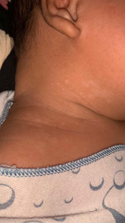 Biang keringet jd putih