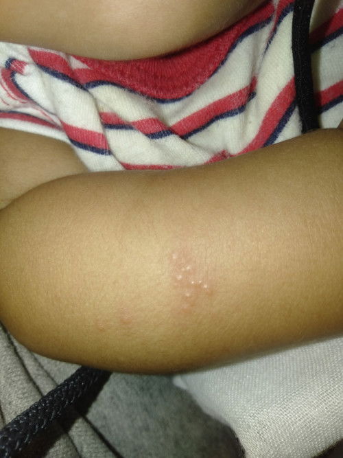 น้อง 3 เดือนมีตุ่มแข็งๆ