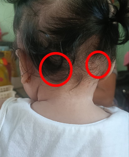 Bukol sa likod ng ulo