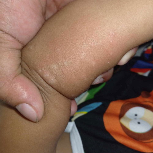 hello po mga mhie. ano po kayang magandang gamot or ointment para dito?