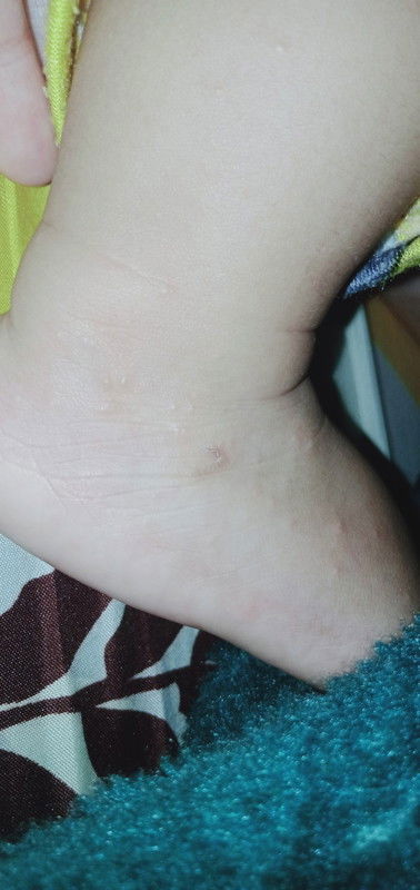 Muncul bintik bintik pada kaki