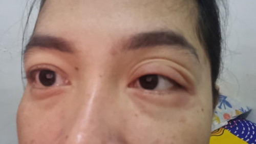 Ada yg sama gak sih bund hamil masuk 17 week mata gatel2 sampek bengkak π₯²