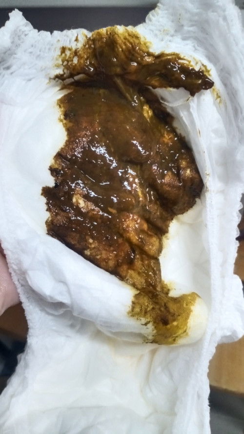 อึแบบนี้ปกติไหม