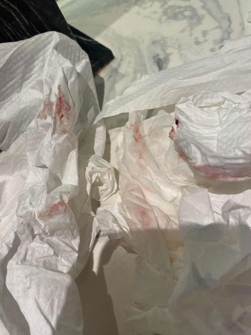 สอบถามค่ะแม่ๆแผลลภายใน หายมั้ยคะ