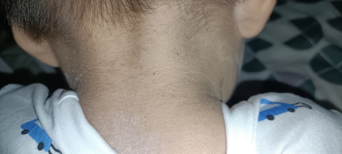 heat rashes?