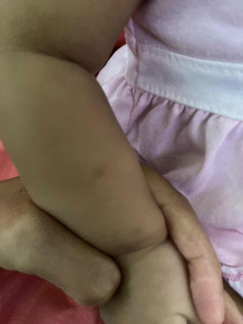 Bekas gigitan nyamuk