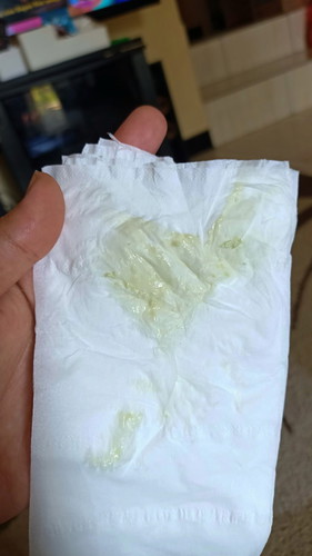 Keputihan & linu di bagian vagina