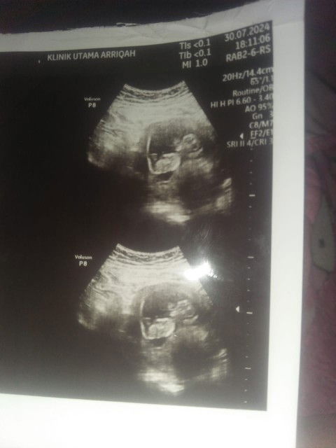 Ada ngak disini bunda yang plasenta nya di bawah🥹
