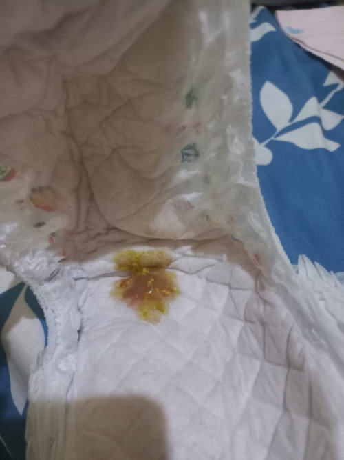 Mau tanya dong buibu, ada yg penah ngalamin kaya gini ga anaknya?